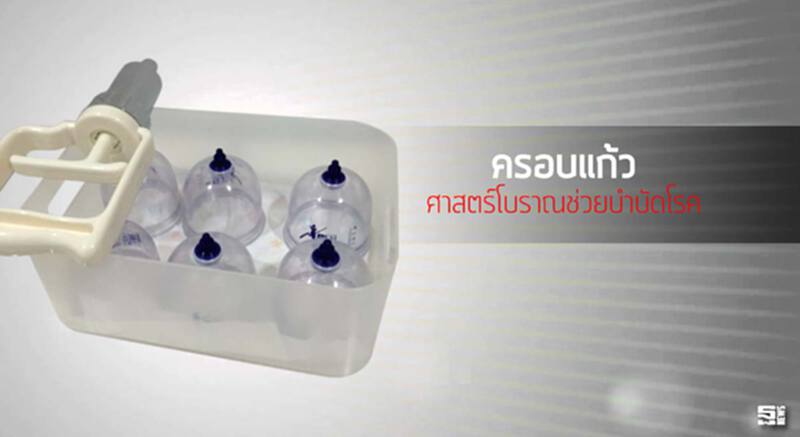 ครอบแก้วศาสตร์โบราณช่วยบำบัดโรค ครอบแก้วศาสตร์โบราณช่วยบำบัดโรค