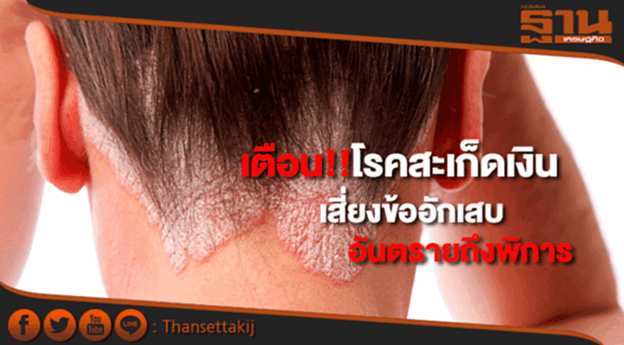 เตือนผู้ป่วยโรคสะเก็ดเงินเสี่ยงข้ออักเสบสะเก็ดเงิน..อันตรายถึงพิการ เตือนผู้ป่วยโรคสะเก็ดเงินเสี่ยงข้ออักเสบสะเก็ดเงิน..อันตรายถึงพิการ