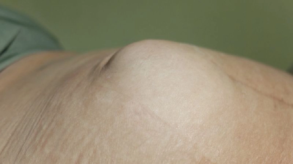 อันตราย!...อย่าปล่อยให้ไส้เลื่อนติดคา (1)