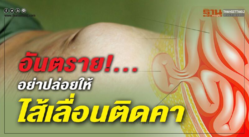 อันตราย!...อย่าปล่อยให้ไส้เลื่อนติดคา (1) อันตราย!...อย่าปล่อยให้ไส้เลื่อนติดคา (1)