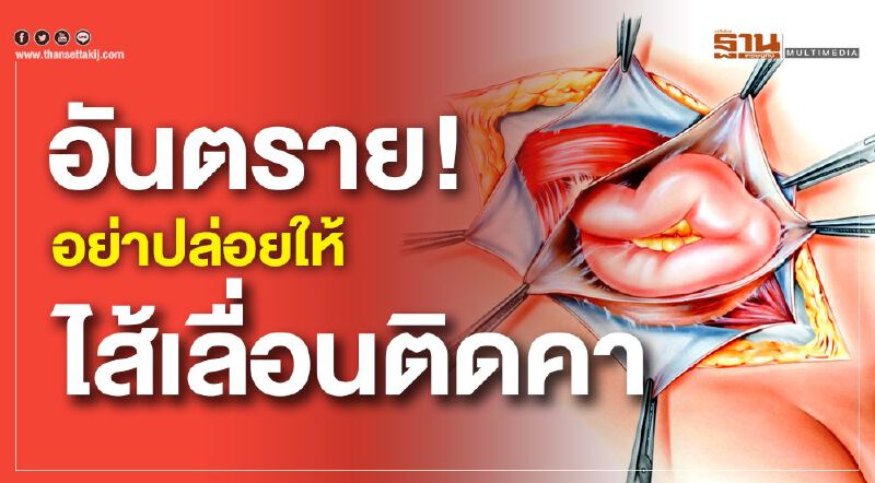 อันตราย!...อย่าปล่อยให้ไส้เลื่อนติดคา