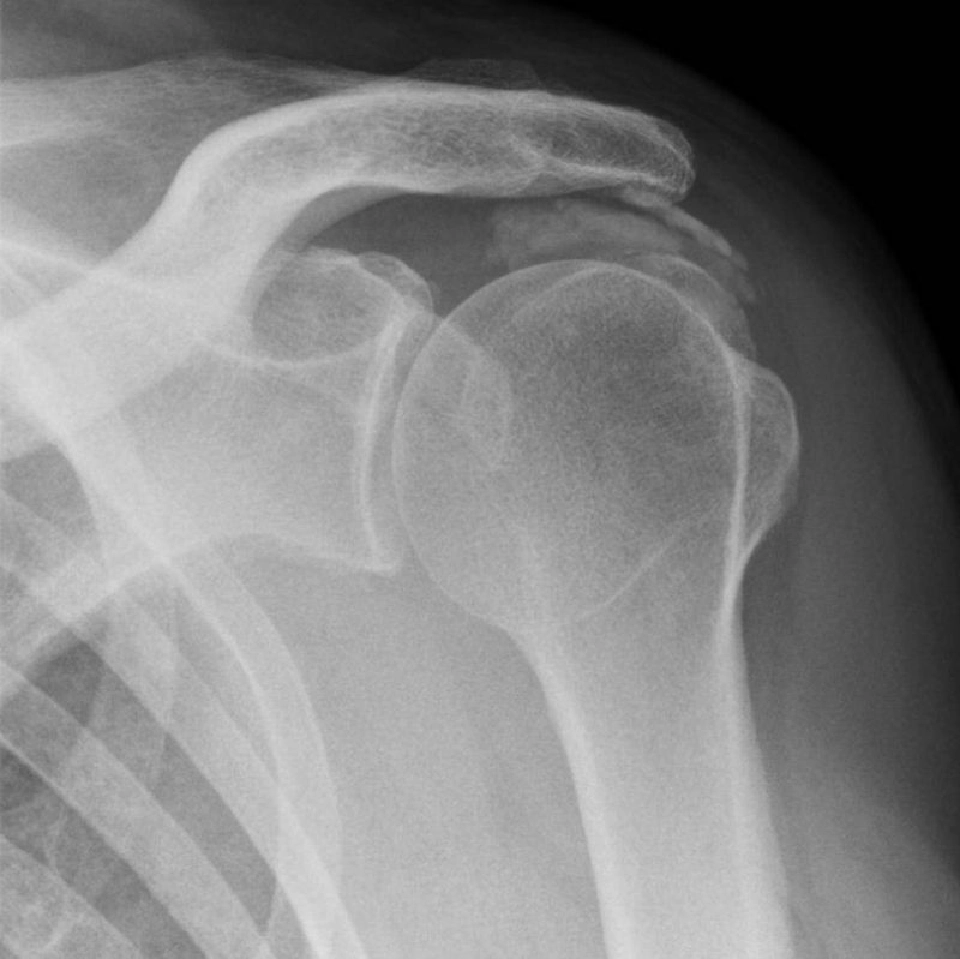 เตือนปวดไหล่ยกแขนไม่สุดสัญญาณกระดูกงอกทับเอ็นข้อไหล่