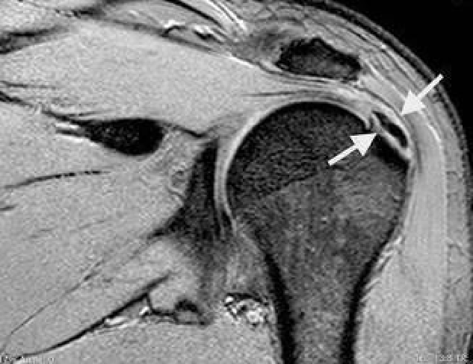 เตือนปวดไหล่ยกแขนไม่สุดสัญญาณกระดูกงอกทับเอ็นข้อไหล่