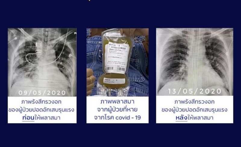 แพทย์ ร.พ. สงขลานครินทร์เจ๋ง ใช้พลาสมารักษาผู้ป่วยโควิด-19 สำเร็จ