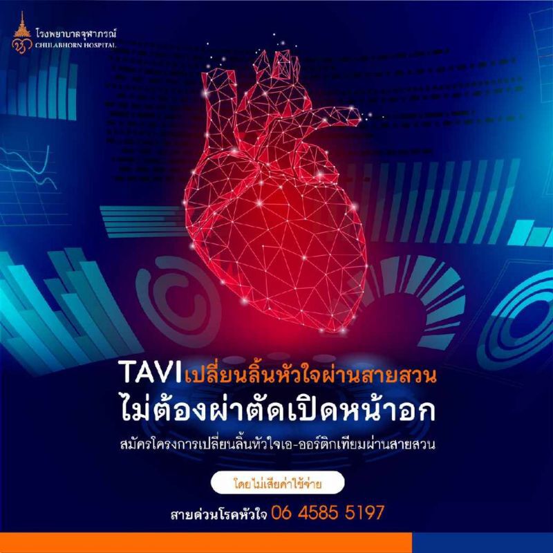 เปิดรับผู้ป่วยรักษาฟรี โรคลิ้นหัวใจเอ-ออร์ติกตีบ 
