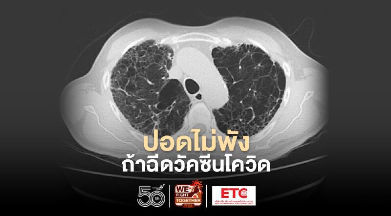 ปอดไม่พังถ้าฉีดวัคซีนโควิด หมอนิธิพัฒน์ชี้ป่วยใส่เครื่องช่วยหายใจ-เสียชีวิตรายวันมากขึ้น 