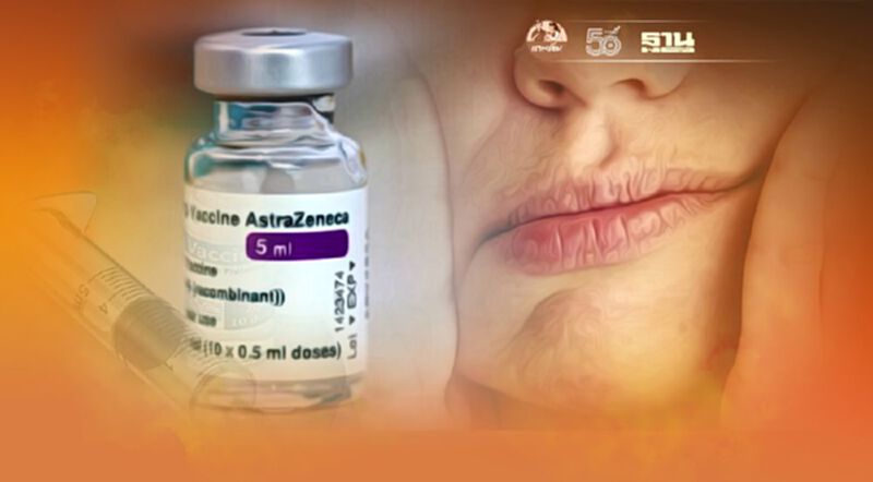 "AstraZeneca" กับผลข้างเคียงแขนขา-กล้ามเนื้อใบหน้าอัมพาตเฉียบพลัน "AstraZeneca" กับผลข้างเคียงแขนขา-กล้ามเนื้อใบหน้าอัมพาตเฉียบพลัน