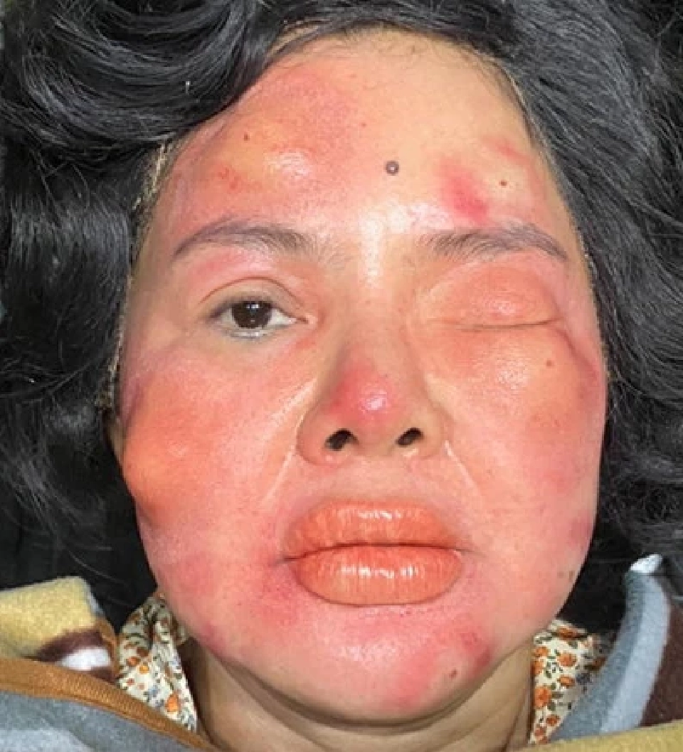 ฮายอาภาพร เป็นอะไร ทำไมหน้าตาบวม