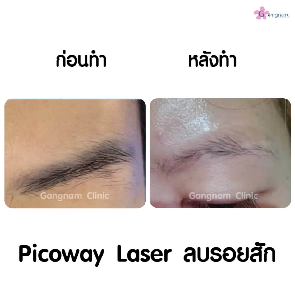 เลเซอร์ลบรอยสักมีหลักการทำงานอย่างไร? ทำไมถึงไม่ทิ้งรอยแผลเป็นหลังทำ?