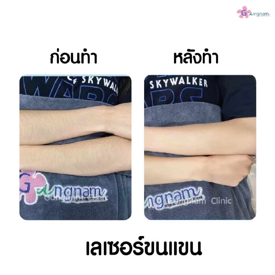 กำจัดขนถาวรด้วยเลเซอร์ แต่ละตัวลงลึกรากขนและมีจุดเด่นต่างกันอย่างไร?