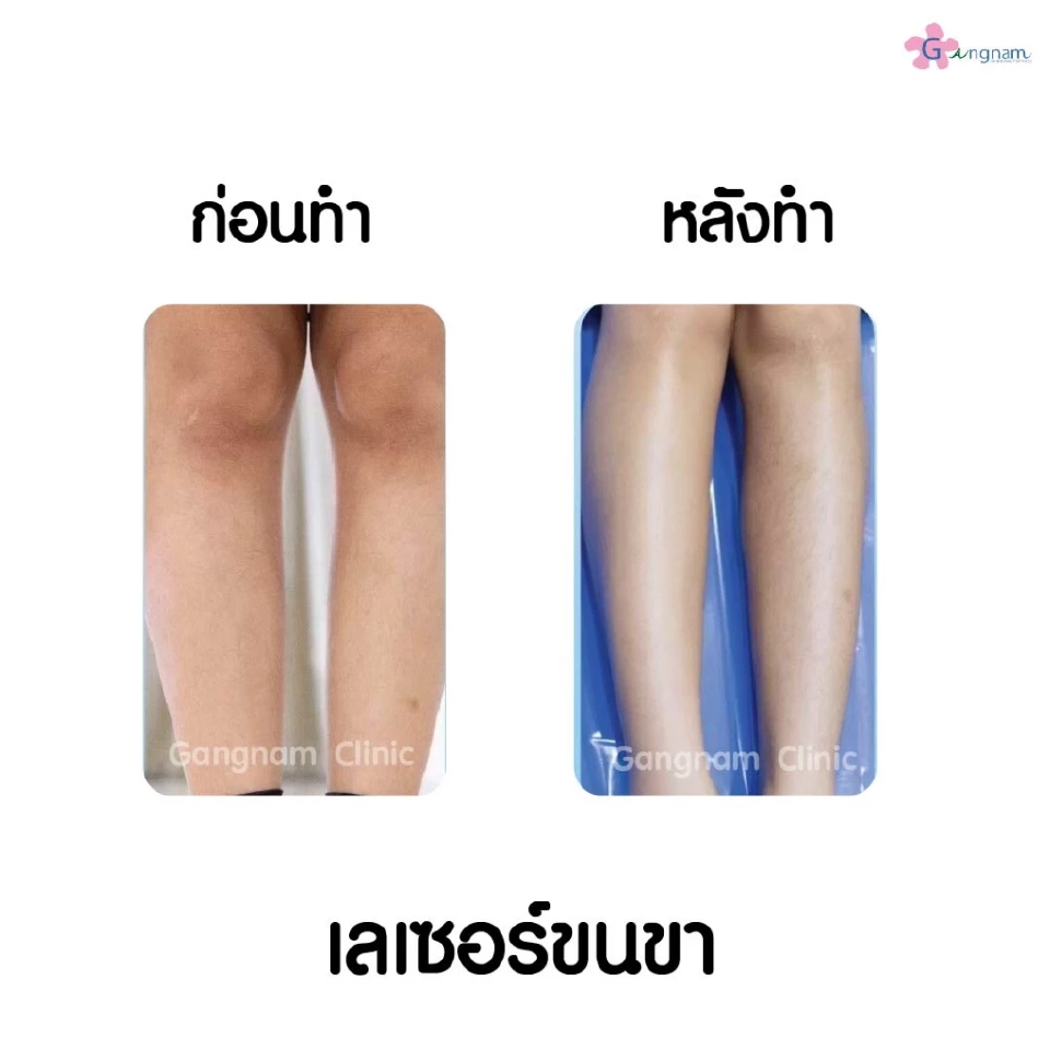 กำจัดขนถาวรด้วยเลเซอร์ แต่ละตัวลงลึกรากขนและมีจุดเด่นต่างกันอย่างไร?