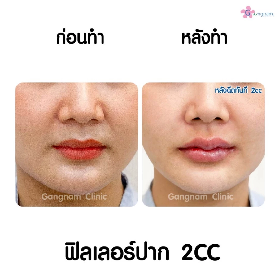 ฉีดฟิลเลอร์ปากกระจับอย่างไรให้สวยเป็นธรรมชาติ และให้เป็นทรงอยู่ได้นาน