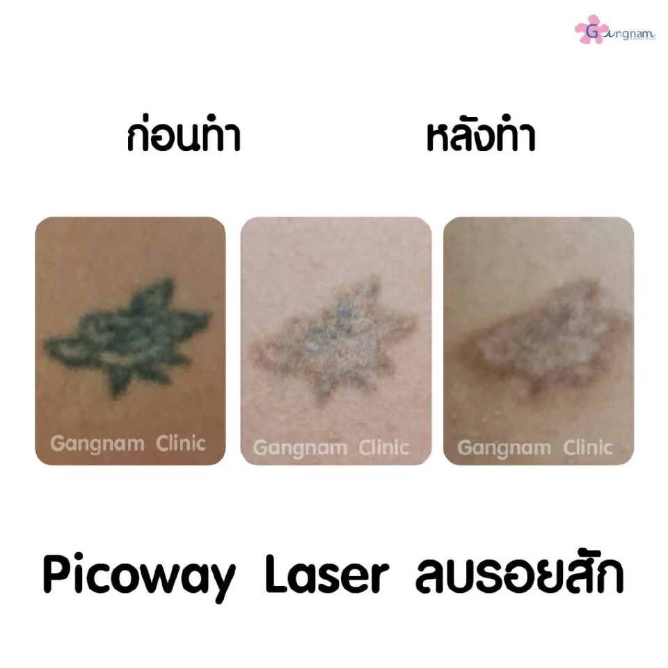 เลเซอร์ลบรอยสักมีหลักการทำงานอย่างไร? ทำไมถึงไม่ทิ้งรอยแผลเป็นหลังทำ?