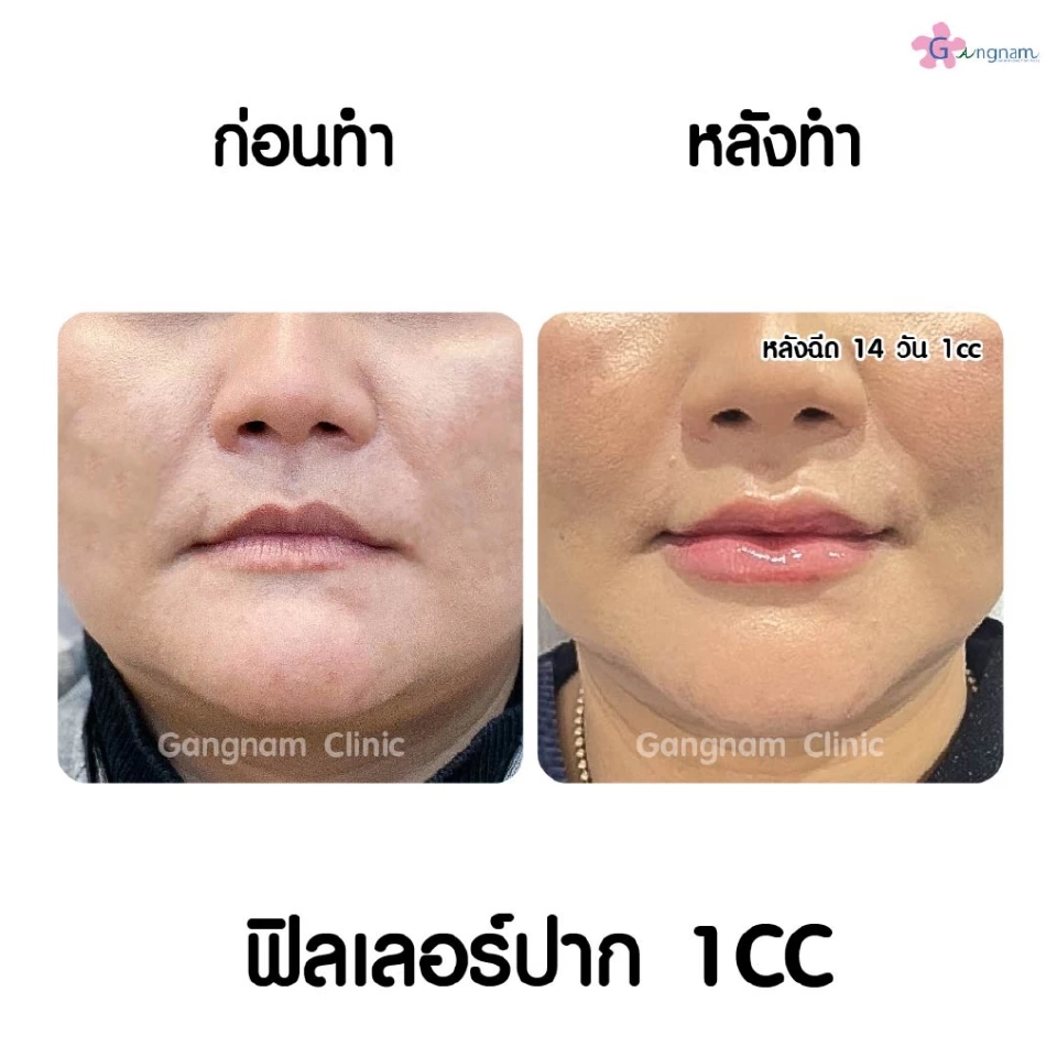 ฉีดฟิลเลอร์ปากกระจับอย่างไรให้สวยเป็นธรรมชาติ และให้เป็นทรงอยู่ได้นาน