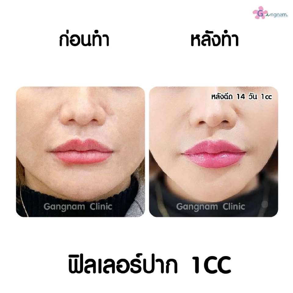 ฉีดฟิลเลอร์ปากกระจับอย่างไรให้สวยเป็นธรรมชาติ และให้เป็นทรงอยู่ได้นาน