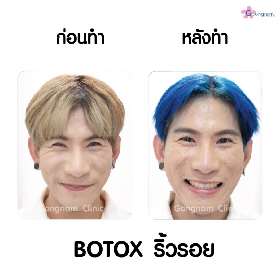 โบท็อกลดริ้วรอยคืออะไร ทำไมคนถึงนิยมลดริ้วรอยด้วยการฉีดโบท็อก??