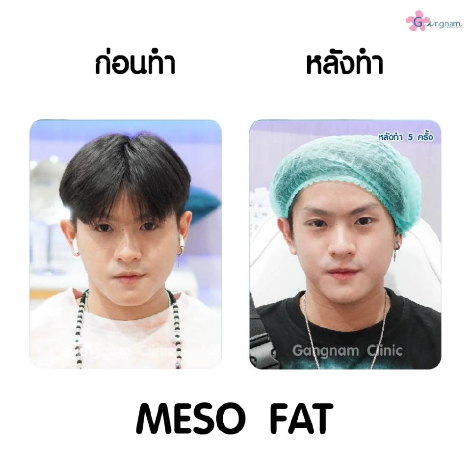 เมโสแฟตสามารถกำจัดไขมันได้อย่างไร? หลังฉีดหน้าเรียวจริงไหม?