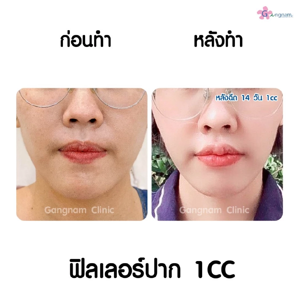 ฉีดฟิลเลอร์ปากกระจับอย่างไรให้สวยเป็นธรรมชาติ และให้เป็นทรงอยู่ได้นาน