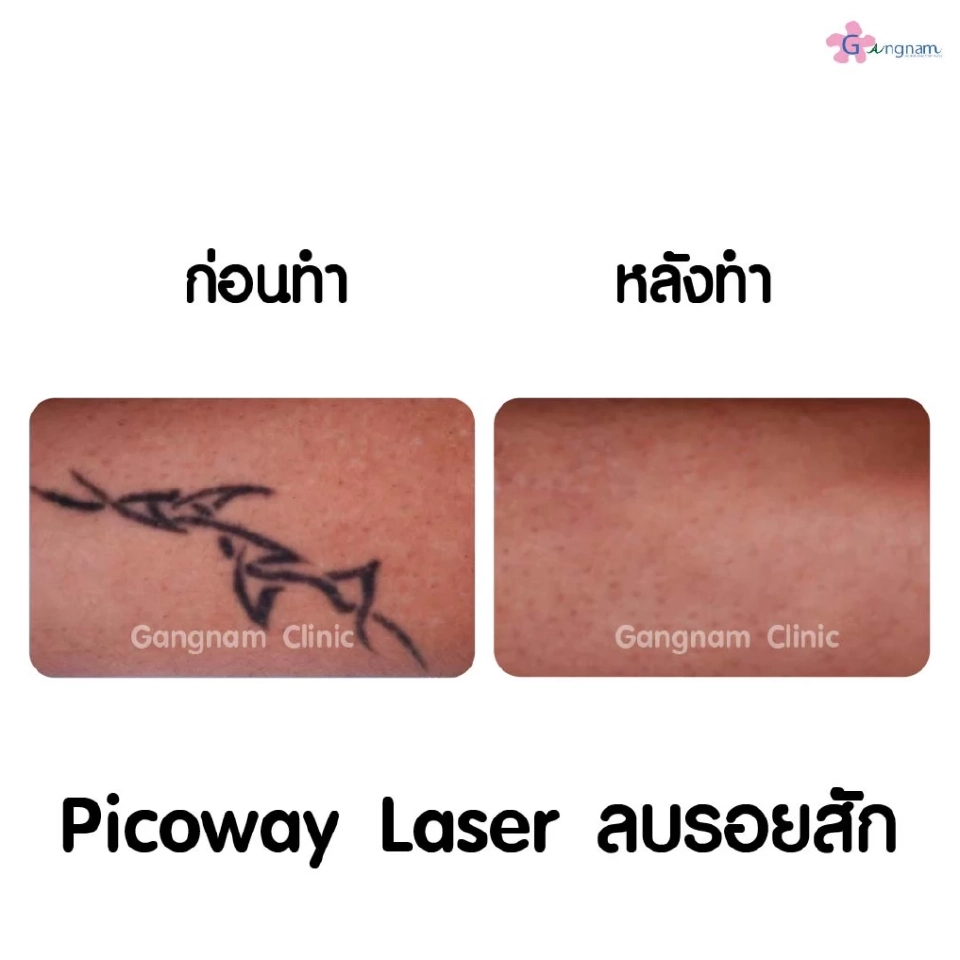 เลเซอร์ลบรอยสักมีหลักการทำงานอย่างไร? ทำไมถึงไม่ทิ้งรอยแผลเป็นหลังทำ?