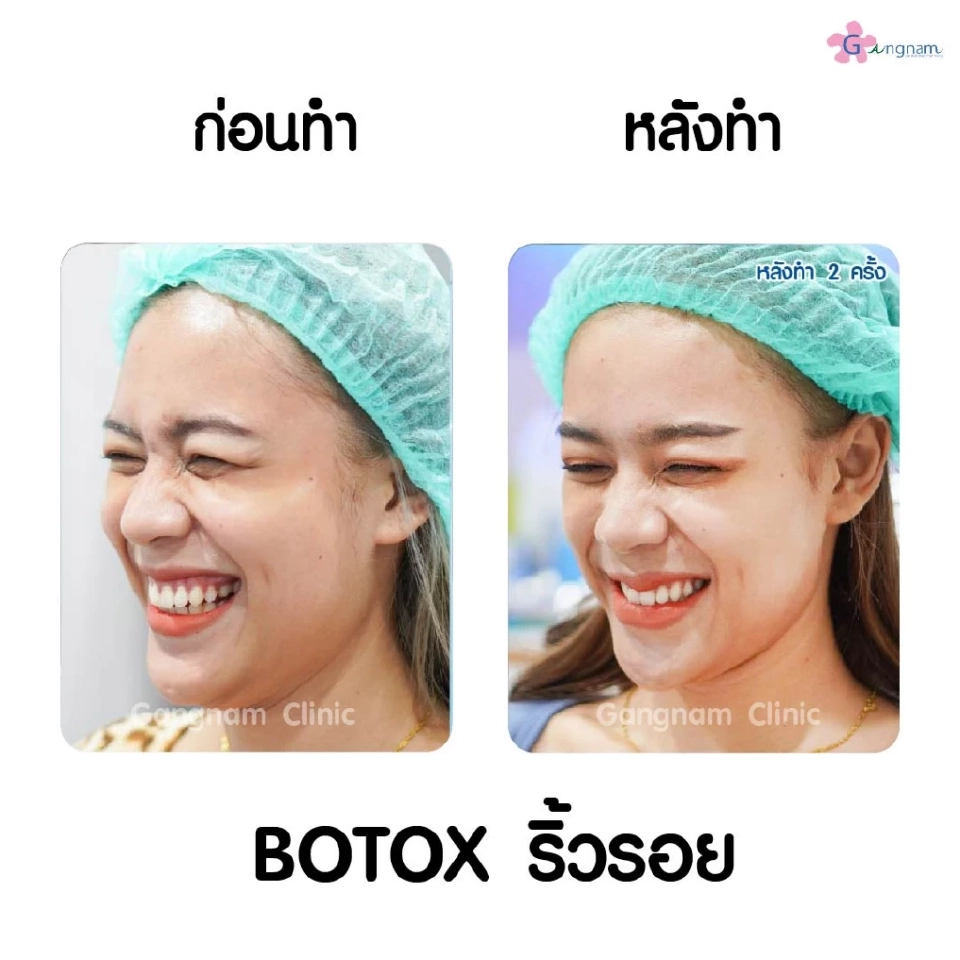 โบท็อกลดริ้วรอยคืออะไร ทำไมคนถึงนิยมลดริ้วรอยด้วยการฉีดโบท็อก??