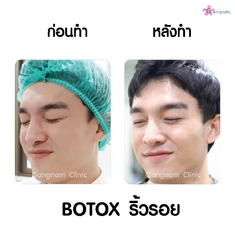 โบท็อกลดริ้วรอยคืออะไร ทำไมคนถึงนิยมลดริ้วรอยด้วยการฉีดโบท็อก??