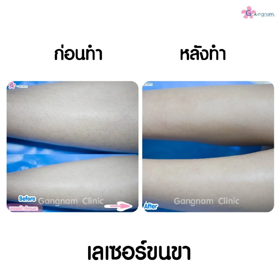 กำจัดขนถาวรด้วยเลเซอร์ แต่ละตัวลงลึกรากขนและมีจุดเด่นต่างกันอย่างไร?