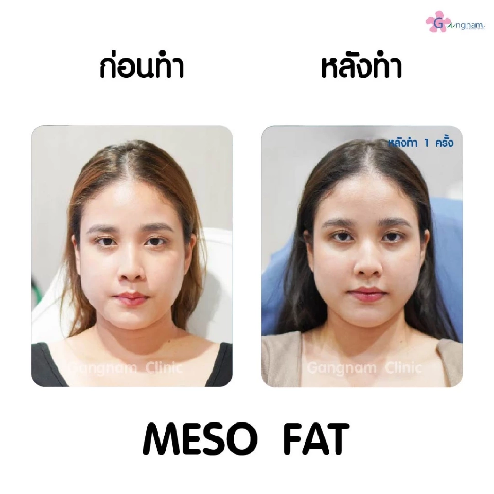 เมโสแฟตสามารถกำจัดไขมันได้อย่างไร? หลังฉีดหน้าเรียวจริงไหม?