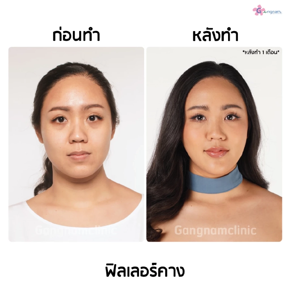 ฉีดฟิลเลอร์คางปรับรูปหน้าให้เรียว โดยไม่ต้องผ่าตัด ใครบ้างควรทำ?