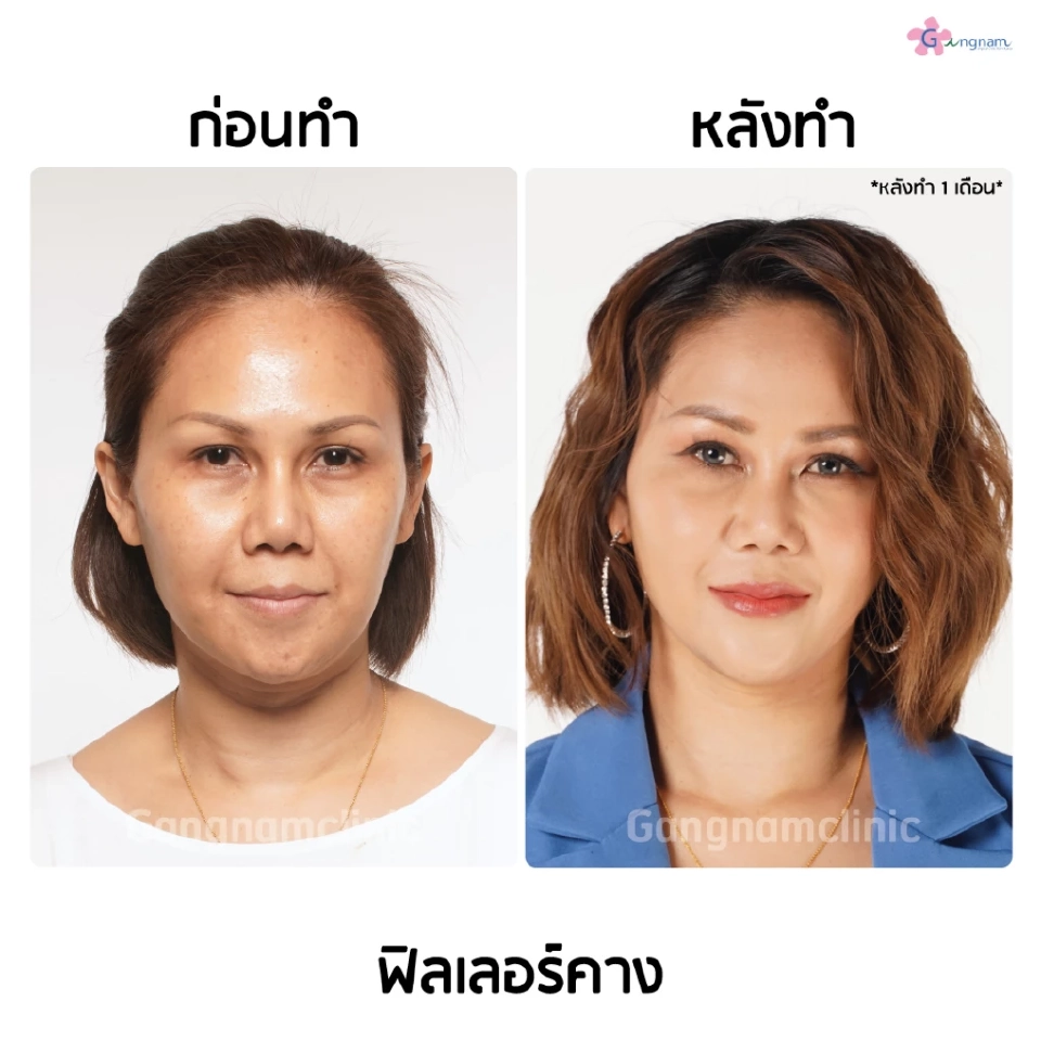 ฉีดฟิลเลอร์คางปรับรูปหน้าให้เรียว โดยไม่ต้องผ่าตัด ใครบ้างควรทำ?