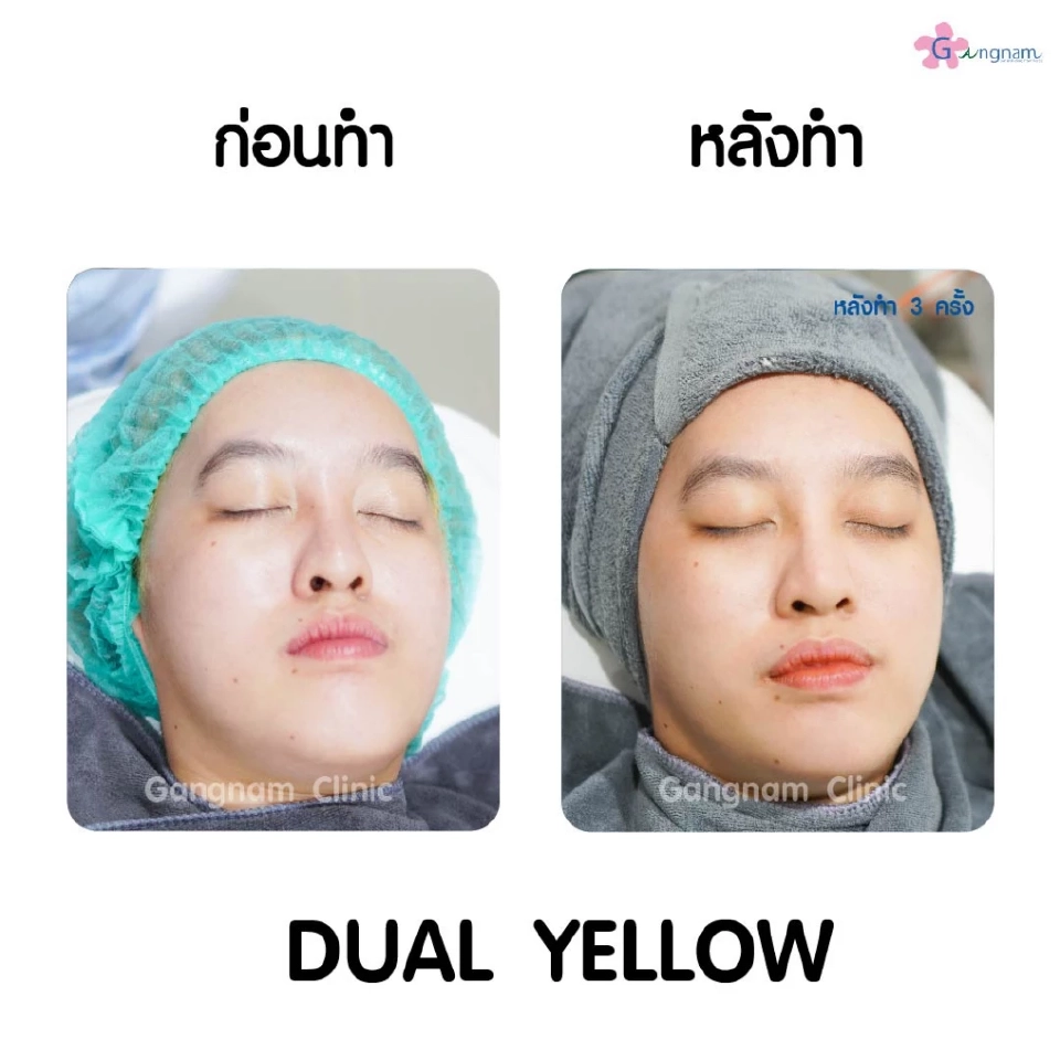 เคล็ดไม่ลับเลเซอร์หน้าใสทำหน้าให้กระจ่างใสเรียบเนียนขึ้นอย่างรวดเร็วได้อย่างไร?