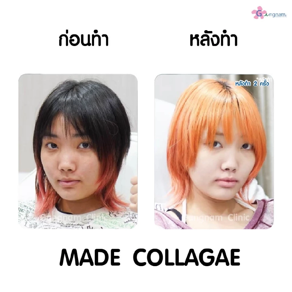 เมโสหน้าใส ตัวช่วยสำหรับฟื้นฟูสภาพให้ผิวหน้าอ่อนเยาว์ดูอิ่มฟูฉ่ำน้ำ