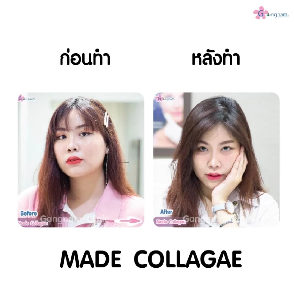 เมโสหน้าใส ตัวช่วยสำหรับฟื้นฟูสภาพให้ผิวหน้าอ่อนเยาว์ดูอิ่มฟูฉ่ำน้ำ