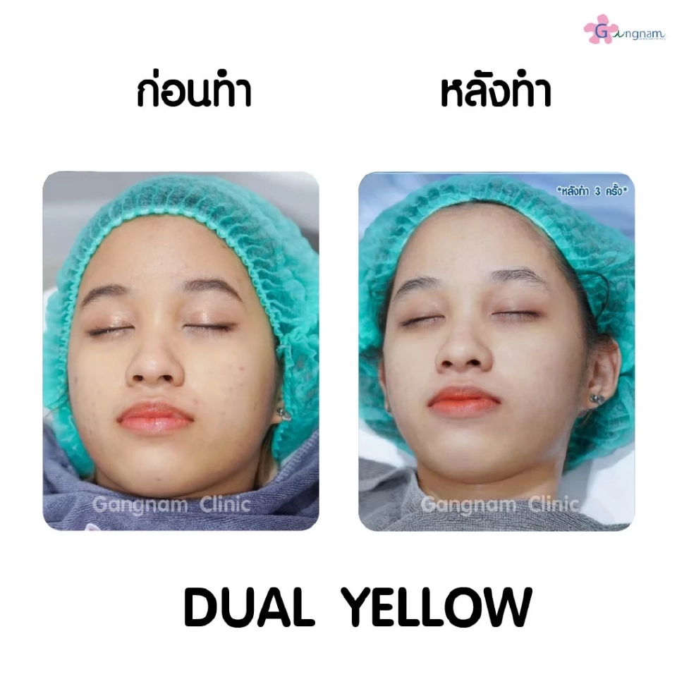 เคล็ดไม่ลับเลเซอร์หน้าใสทำหน้าให้กระจ่างใสเรียบเนียนขึ้นอย่างรวดเร็วได้อย่างไร?