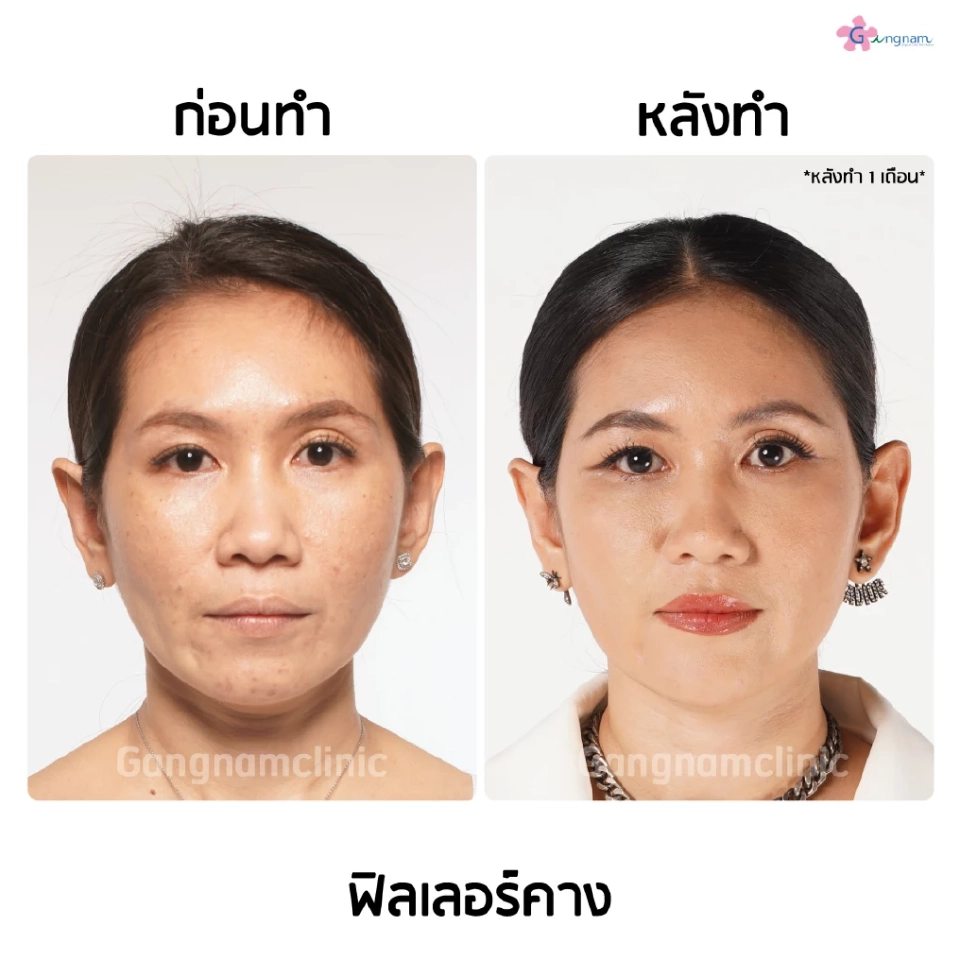 ฉีดฟิลเลอร์คางปรับรูปหน้าให้เรียว โดยไม่ต้องผ่าตัด ใครบ้างควรทำ?