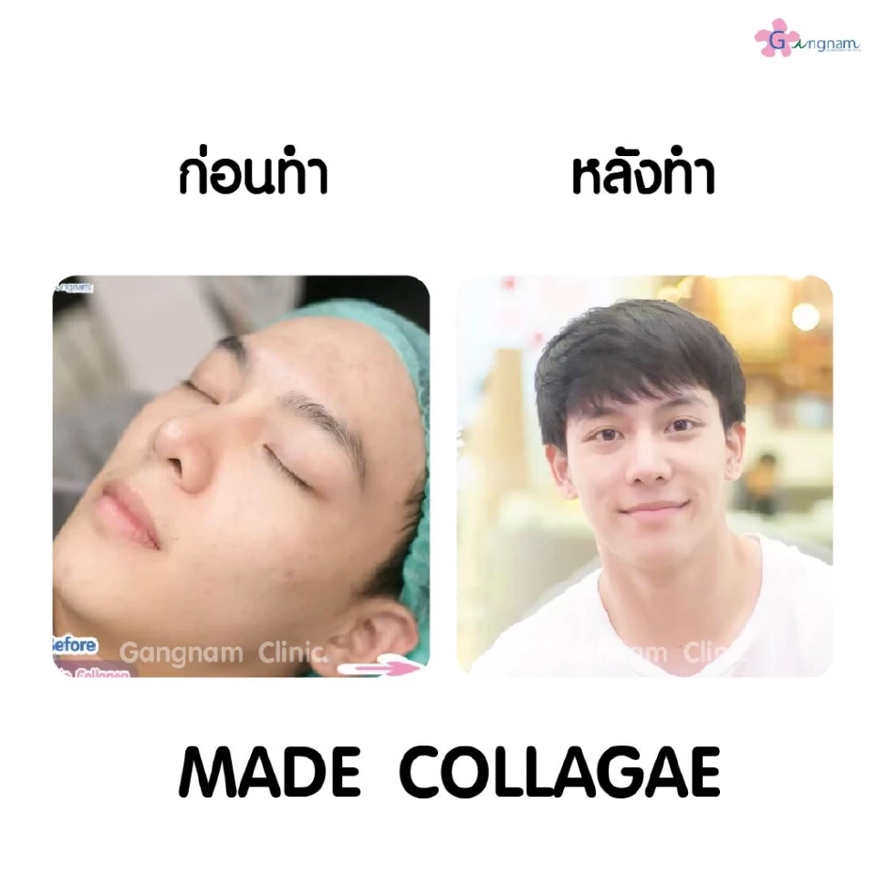 เมโสหน้าใส ตัวช่วยสำหรับฟื้นฟูสภาพให้ผิวหน้าอ่อนเยาว์ดูอิ่มฟูฉ่ำน้ำ