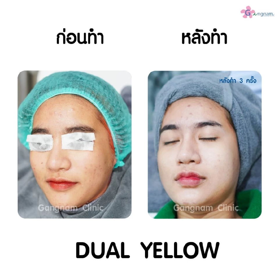 เคล็ดไม่ลับเลเซอร์หน้าใสทำหน้าให้กระจ่างใสเรียบเนียนขึ้นอย่างรวดเร็วได้อย่างไร?