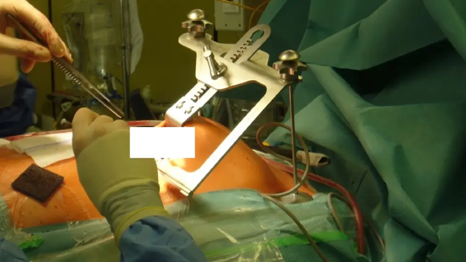 ผ่าแนวคิด 3 ศัลยแพทย์ผู้เชี่ยวชาญด้าน “เทคนิคการผ่าตัดแผลเล็ก”