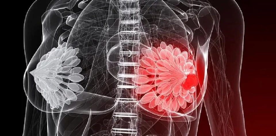 7 ตุลาคม วันมะเร็งเต้านมสากล