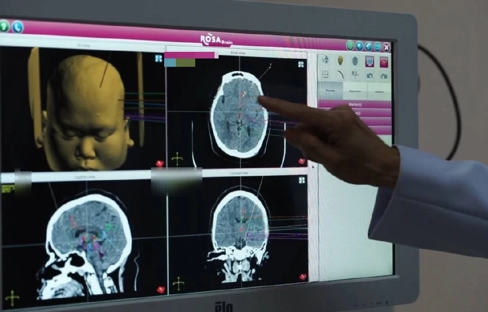 หุ่นยนต์ช่วยผ่าตัดสมองฝีมือหมอไทย ความหวังใหม่ผู้ป่วยโรคลมชัก