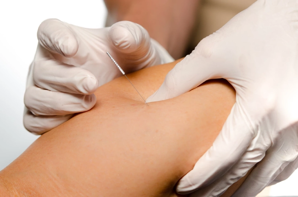 “ฝังเข็มแห้ง” ทางเลือกใหม่ “ออฟฟิศซินโดรม” โดยไม่ต้องพึ่งยา