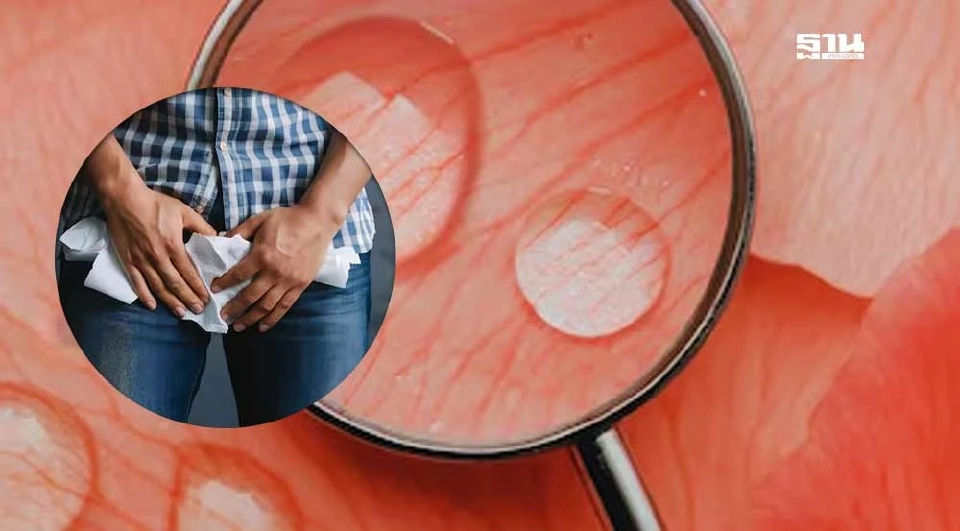 หนองในแท้-หนองในเทียม อาการต่างกันอย่างไร  ป้องกันได้หรือไม่