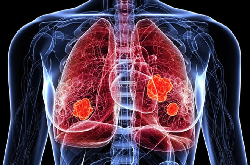 สถาบันมะเร็งแห่งชาติ เผยปัจจัยเสี่ยงผู้หญิงไทย "ป่วยมะเร็งปอด" top 2 ของโลก