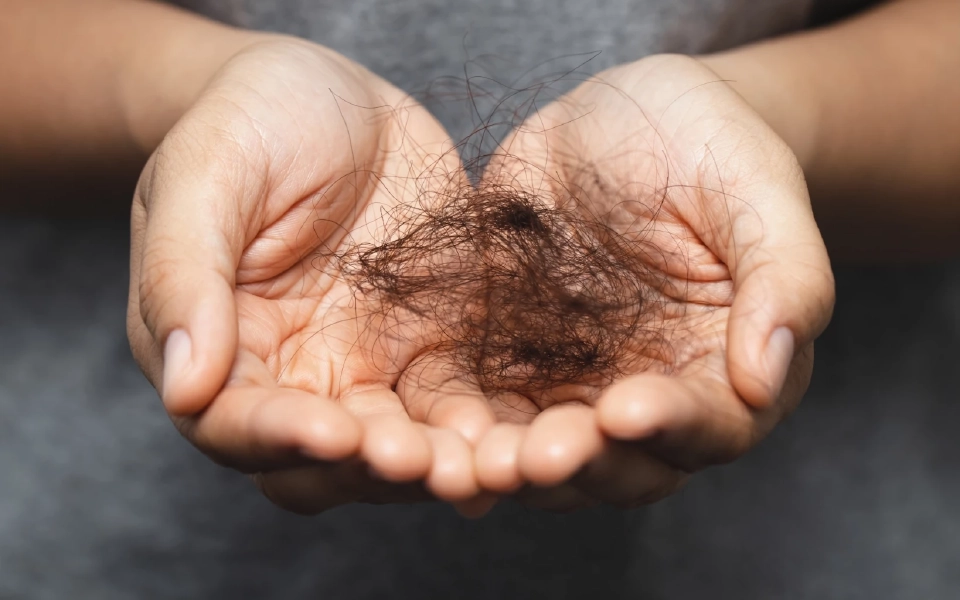 แพทย์ชี้ เครียดทำให้ “ผมร่วง-หัวล้าน” จริงหรือไม่ พร้อมวิธีรับมือและการรักษา