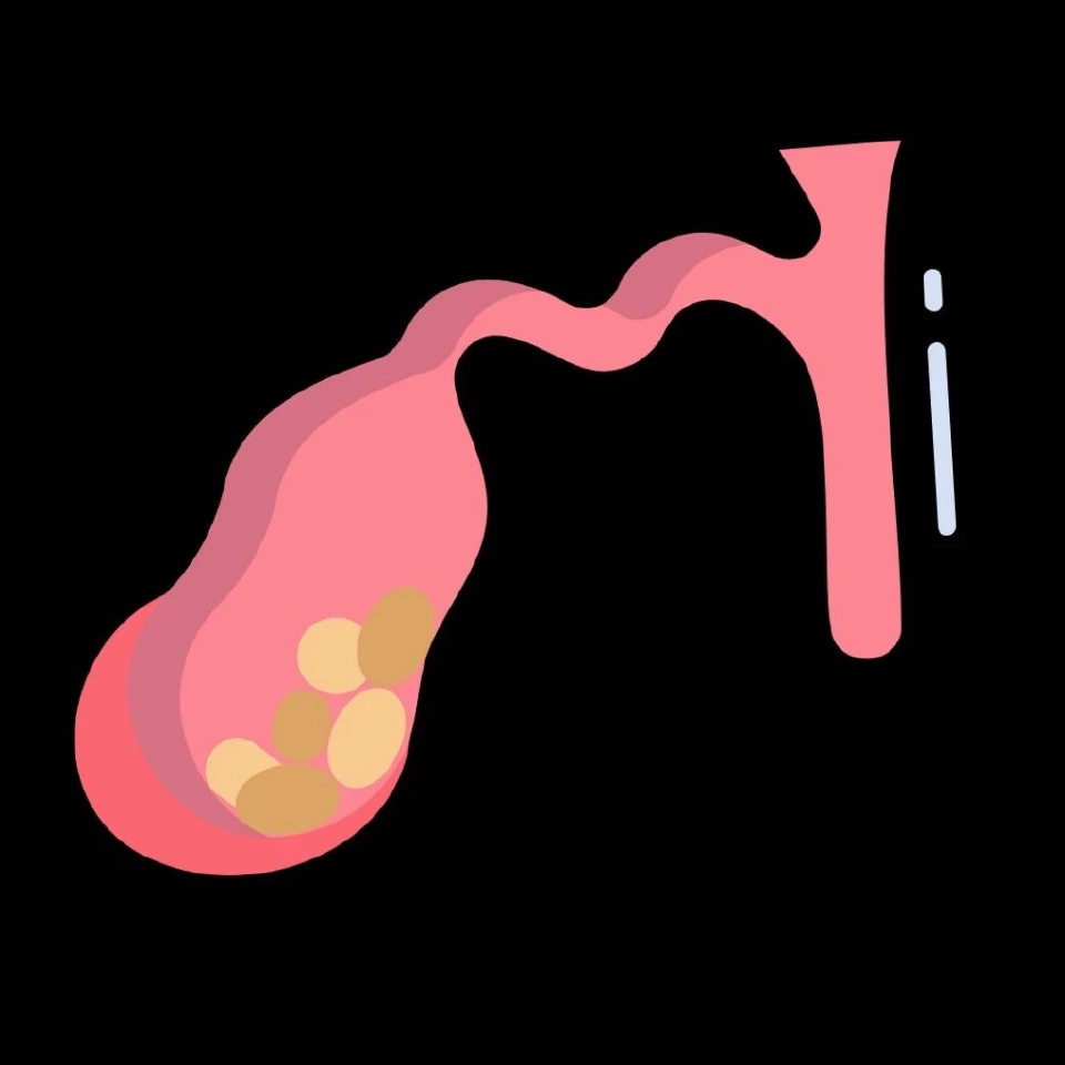 ปวดท้องรุนแรง ระวัง ‘ถุงน้ำดีอักเสบ’ อาจเกิดภาวะแทรกซ้อน