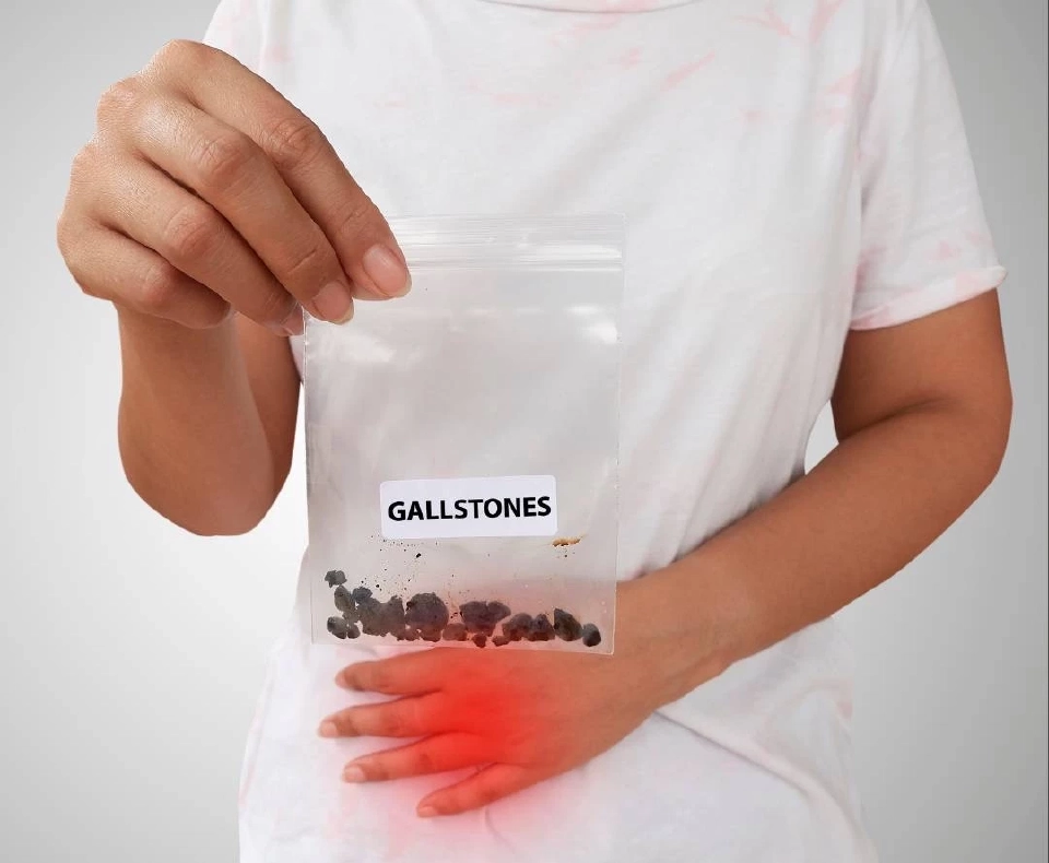 ปวดท้องรุนแรง ระวัง ‘ถุงน้ำดีอักเสบ’ อาจเกิดภาวะแทรกซ้อน