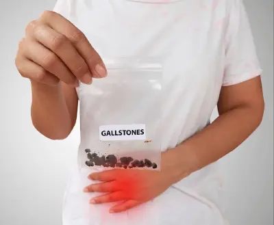 Illustration of the gallbladder and‌ gallstones