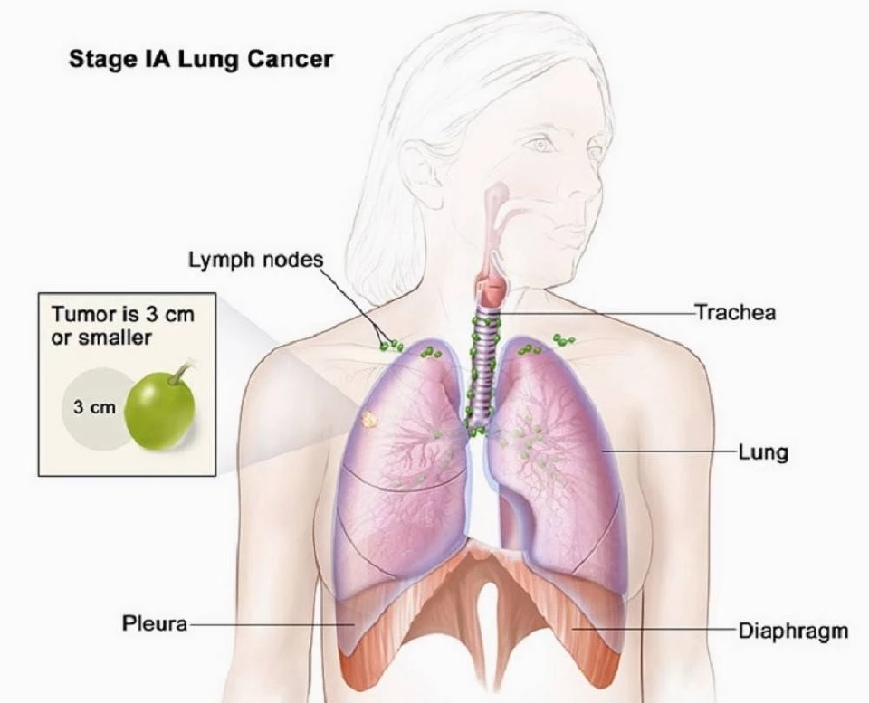 แพทย์แนะข้อควรปฏิบัติ ตรวจเจอฝ้าขาวที่ปอด อาจมีความเสี่ยงโรคมะเร็ง