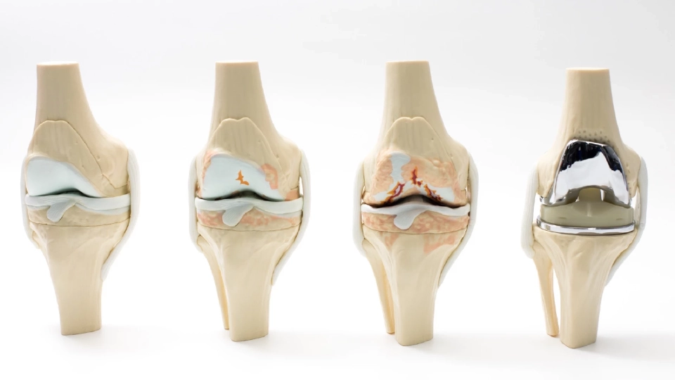 ‘ข้อเข่าเสื่อม’ โรคยอดฮิตในผู้สูงอายุ ระดับความรุนแรงแบบไหนต้องผ่าตัด