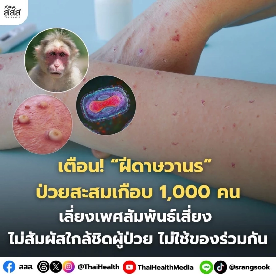 ผู้ป่วย ‘ฝีดาษวานร’ ในไทยพุ่งพันราย เร่งฉีดวัคซีน 4 พื้นที่