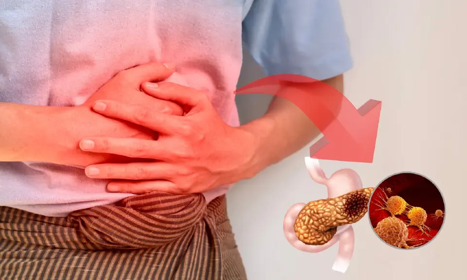 มะเร็งตับอ่อน ภัยเงียบที่คร่าชีวิตสูง